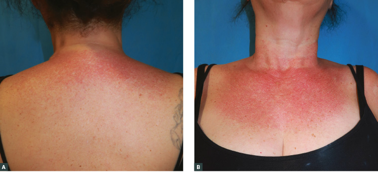AJGP-08-2019-Clinical-Fernandez-Nieto-Typical-Red-Neck-Fig-1.jpg AJGP-08-2019-Clinical-Fernandez-Nieto-Typical-Red-Neck-Fig-1.jpg