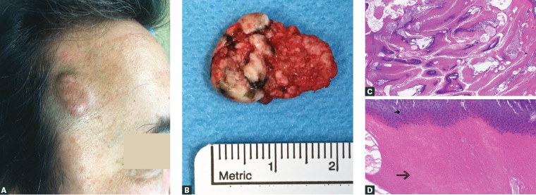 Raposo Firm Nodules