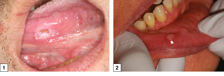 AJGP-09-2020-Focus-Wong-Common-Oral-Mucosal-Disease-Fig-1-2.jpg Figure 1. Symptomatic traumatic ulceration of the left mid-ventral tongue associated with a sharp left lower molar. The ulcer has flat edges and is surrounded by an area of frictional keratosis. The ulcer was soft on palpation. Figure 2. Minor aphthous ulceration of the lower right labial mucosa with typical erythematous hallow and yellow base.