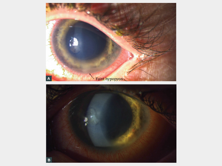 Figure 1. Left eye examination findings